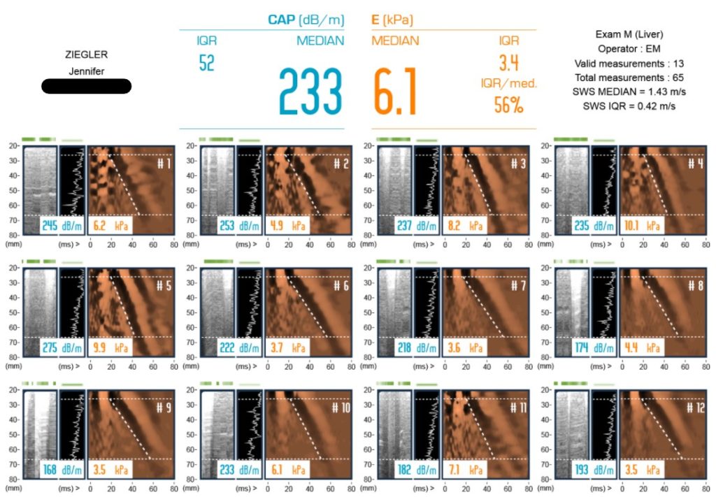 Screenshot of my 12 FibroScan and my CAP and Elasticity test results