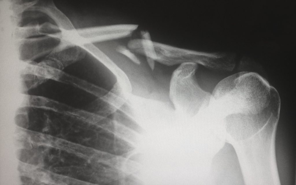 X-ray of human shoulder for bone density scan